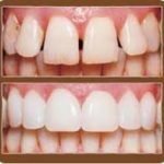 Cosmetic dentistry