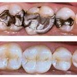 Fillings